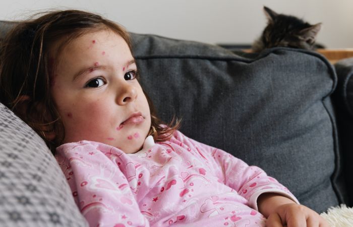 Sarampión en niños: ¿está España en riesgo por los brotes europeos?